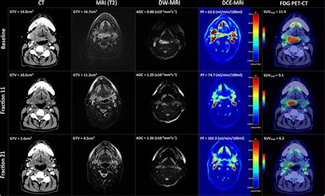 Multi Modality Imaging Changes During Radiotherapy A Case Of A Patient