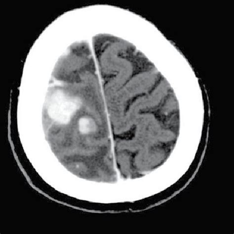 Inflammation infiltrating into the parenchyma of the brain and... | Download Scientific Diagram