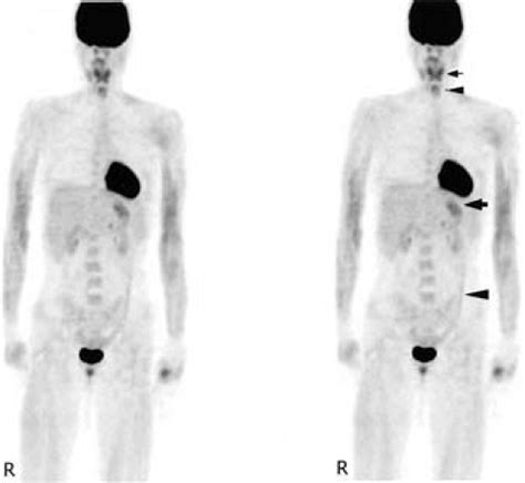 Artifacts and Normal Variants in FDG PET | Radiology Key