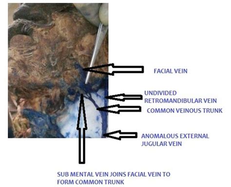 Figure From Anatomical Variations In The Superficial Veins Of Head