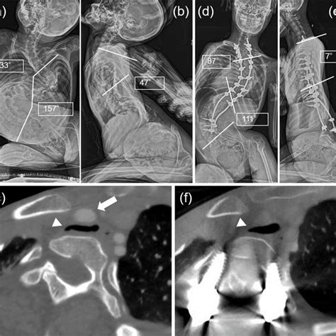 Mri Scan Showing Tracheal Compression By The Innominate Artery In Case