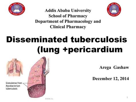 Disseminated Tb Ppt