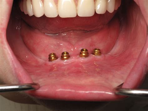 Dental Implant Overdenture Locator AttachmentsPatient Information