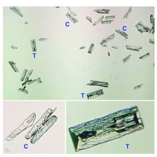 Optical microscopy of struvite crystals from human urine at 40x ...