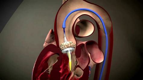 Tavr Procedure Youtube