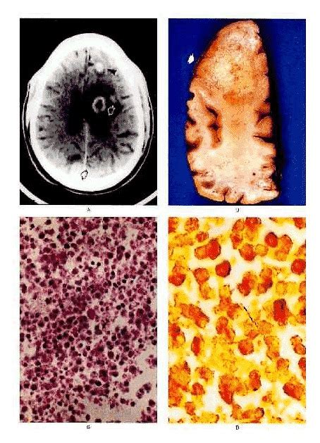 Primary Syphilis Histology