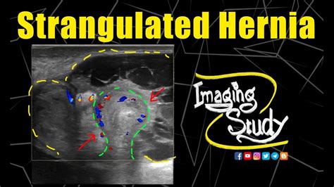 Strangulated Umbilical Hernia With Abscess Formation Ultrasound Doppler Case 199 Youtube