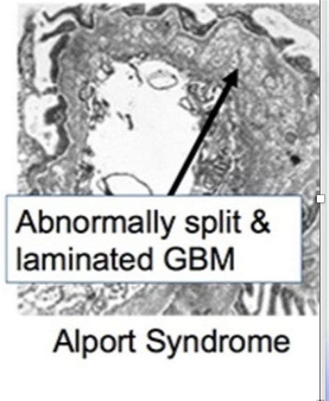 What is Alport Syndrome? How does it present as? - Dr Shashikant ...
