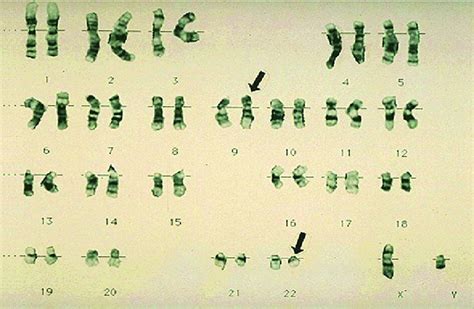 Karyogram Shows Diagnostic Cytogenetic Abnormality T 9 22 In A