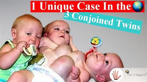 Conjoined Triplets Photos