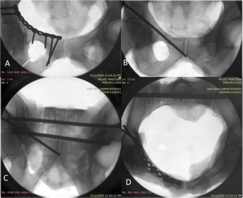 A Biomechanical Comparison Of Superior Ramus Plating Versus