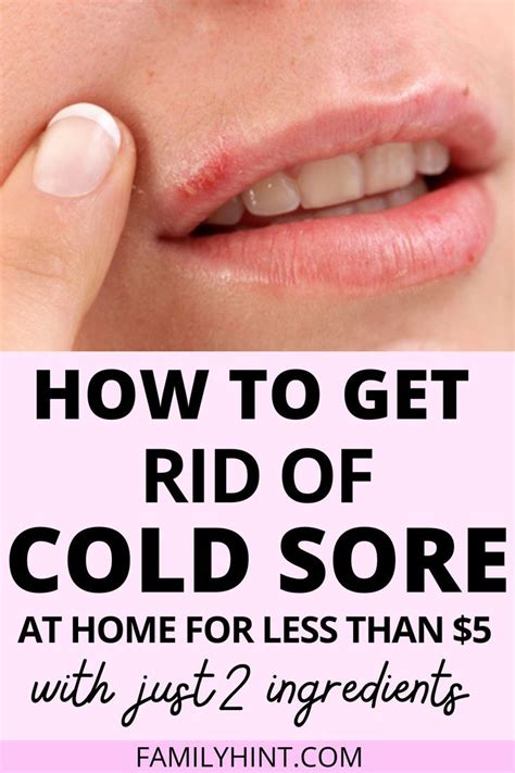 Fast And Effective 8 Natural Cold Sore Remedies That Work Artofit