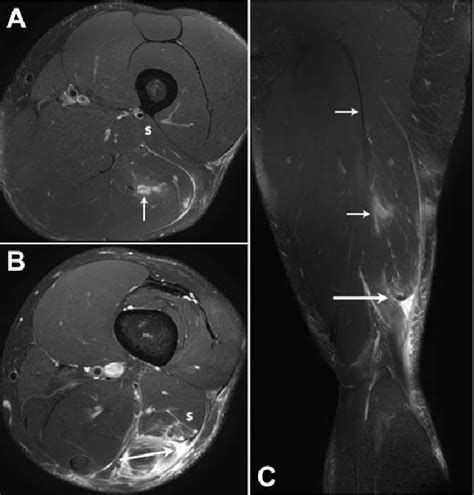 Figure 10 From Distal Musculotendinous T Junction Injuries Of The Biceps Femoris An Mri Case