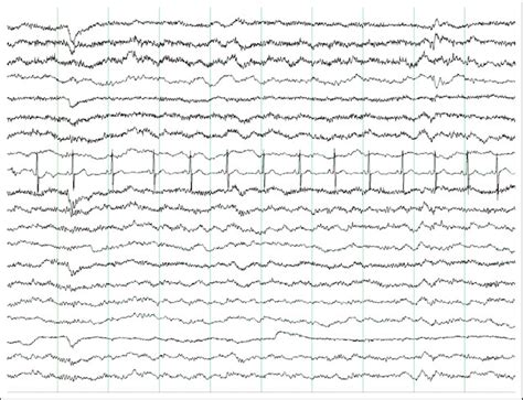 Electroencephalography 10 S Page Amplitude 50 MV Cm Patient 2 Age 6