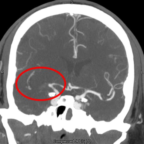 Acute Ischemic Stroke From Mca Occlusion