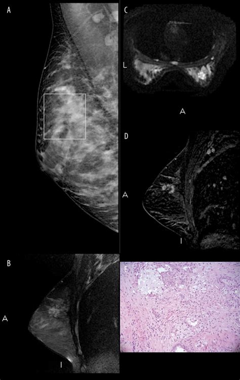 Sclerosing Adenosis Of The Breast Report Of Two Cases And Review Of