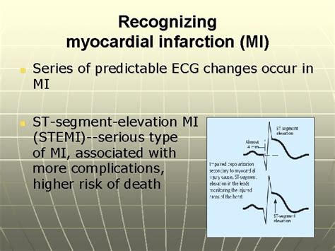 Understanding The 12 Lead Ecg Part Ii By