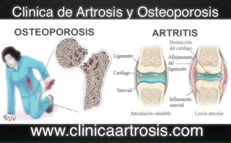 Clínica De Artrosis Y Osteoporosis Sa