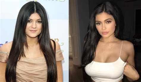 Kylie Jenner's Plastic Surgery Transformation | The Blemish