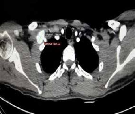 Angiotem Corte Axial Pseudoaneurisma De Arteria Subclavia Derecha