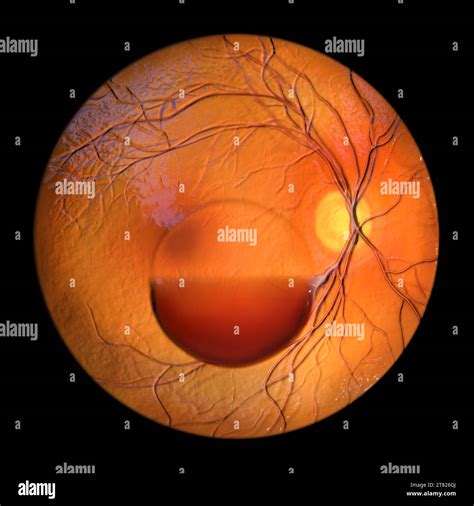 Illustration Of A Subhyaloid Haemorrhage On The Retina As Observed