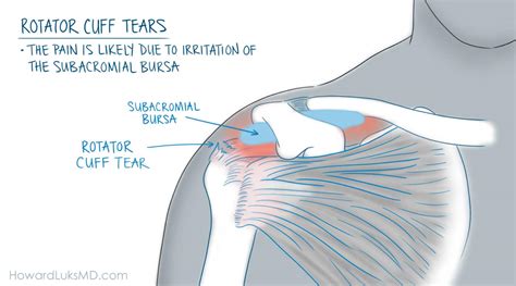 Rotator Cuff Tears And Shoulder Pain At Night