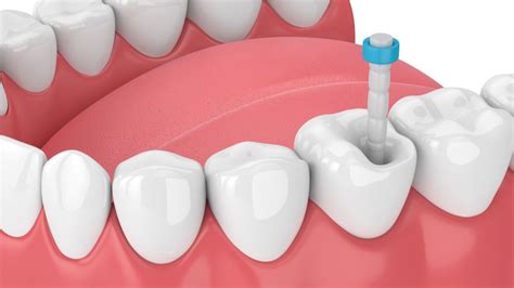 Quanto Custa Colocar Pino No Dente Veja O Que Muda O Valor