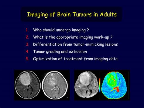 Ppt Adult Brain Tumors Powerpoint Presentation Free Download Id 287986