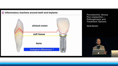 Periodontitis Versus Peri Implantitis Pathogenesis And Treatment