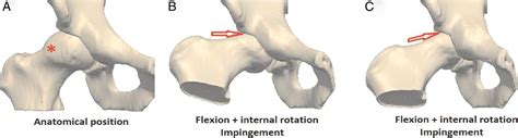 What Is Femoroacetabular Impingement British Journal Of Sports Medicine