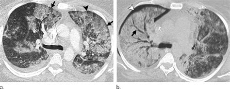 EVALI: Lung scans show how vape illness tears through the lungs