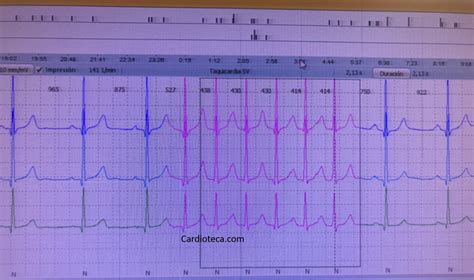 Curso ECG Taquicardia supraventricular paroxística en paciente con