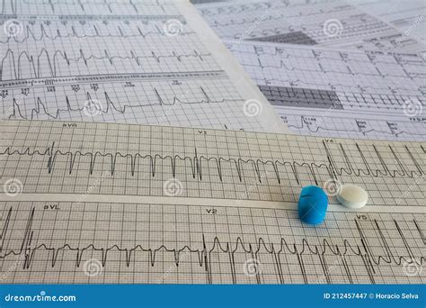 Electrocardiogram With Cardiac Arrhythmia Medications For Arrhythmia