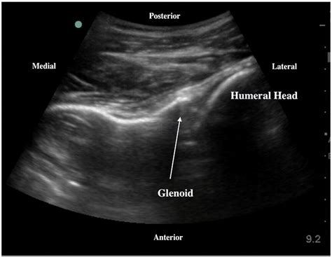 Point Of Care Ultrasound Diagnosis And Treatment Of Posterior Shoulder Dislocation The