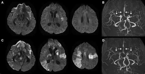 Cerebral Vasculitis Due To Invasive Disseminated Streptococcus