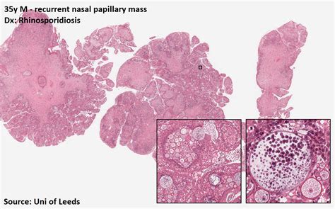 Pathology Outlines Rhinosporidiosis