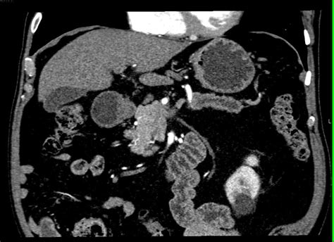 Intraductal Papillary Mucinous Neoplasm Ipmn Pancreas Pancreas Case