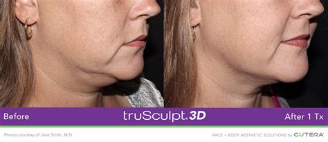 Trusculpt 3d Treatment Near Boston Ma Wellesley Ma