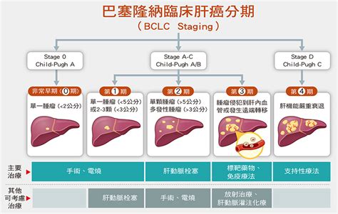 肝癌如何「除惡務盡」？ 秤子維的秘密花園 Udn部落格