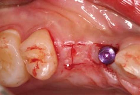 Figure 1 From I Shaped Incisions For Papilla Reconstruction In Second