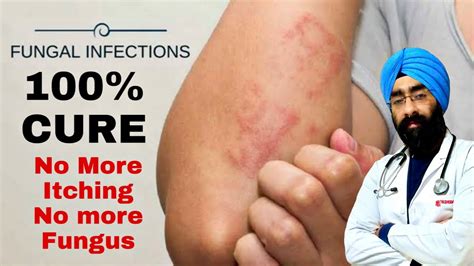 Best Treatment Of Fungal Skin Infections Expert Advice Dr Education