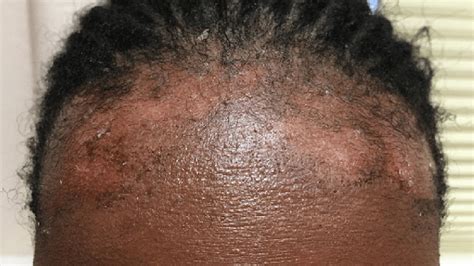 Eczema On Scalp African American