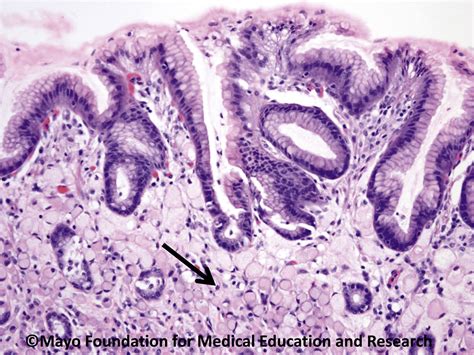 Gastric Signet Ring Cell Carcinoma Mayo Clinic Proceedings