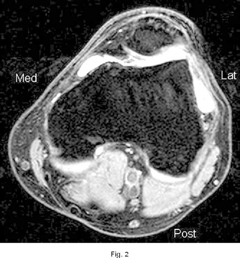 Vastus Medialis Oblique Mri