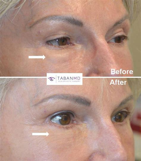 Lower Blepharoplasty Scars