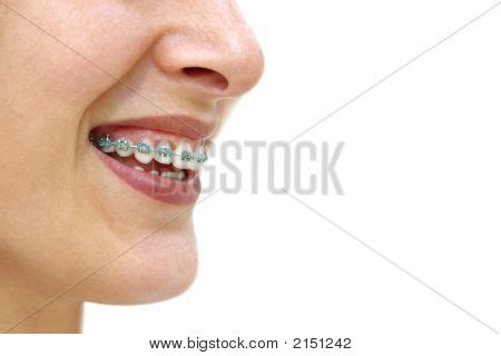 Teeth Braces Image & Photo (Free Trial) | Bigstock