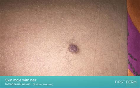 Dermal Nevus