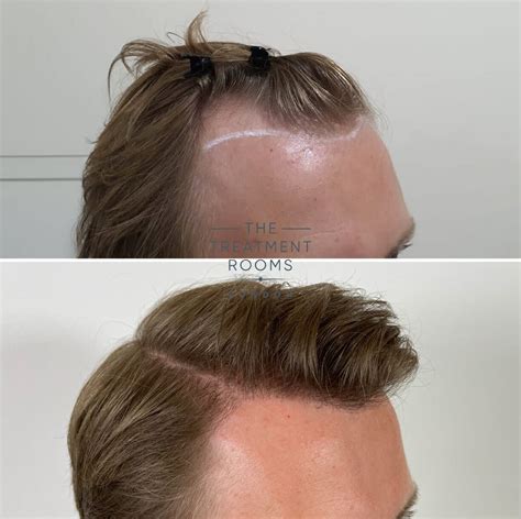 FUE Transplant Before After Treatment Rooms London