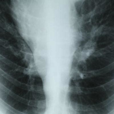 Chest tightness and wheezing | Severe Asthma Challenge Center