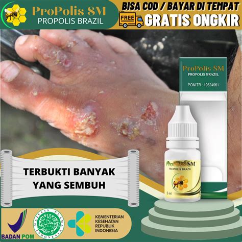 Obat Gudik Pada Manusia Obat Gudikan Budukan Scabies Eksim Panu